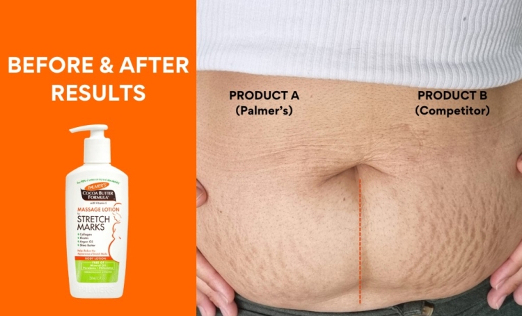 woman with stretch marks and results after using palmers